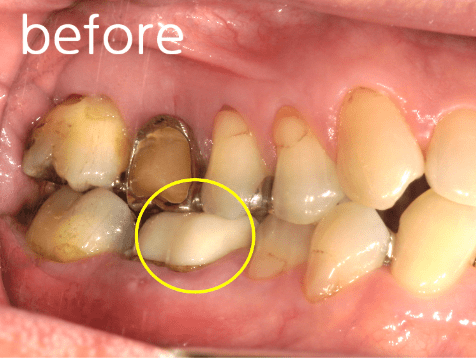 森山歯科 インプラント治療 術前